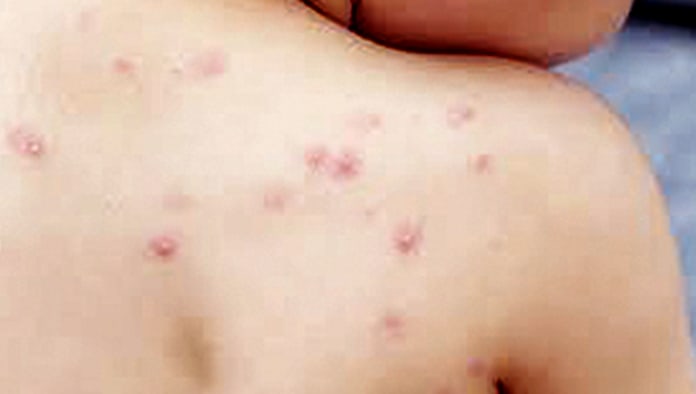 Desata sicosis viruela s&iacute;mica